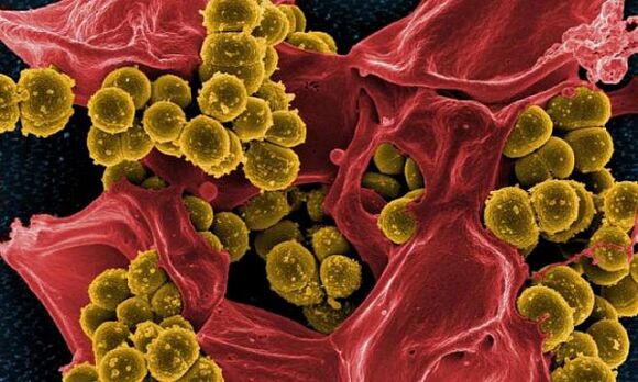 Staphylococcus aureus jako příčina bakteriální prostatitidy