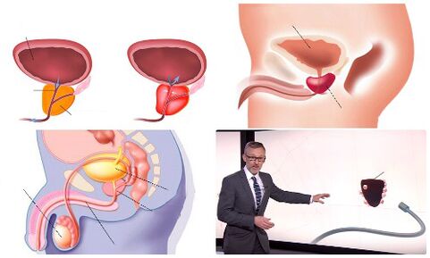 zdravá a nemocná prostata